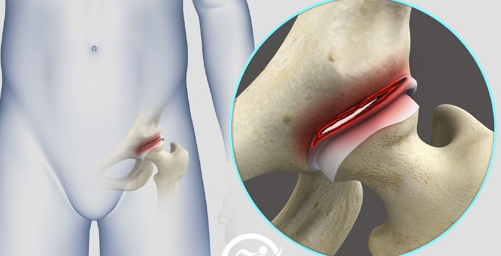 پارگی لابروم لگن و راه درمان آن با فیزیوتراپی