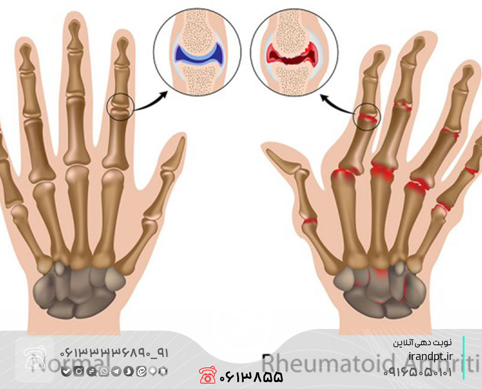 درمان آرتریت روماتوئید انگشتان با فیزیوتراپی