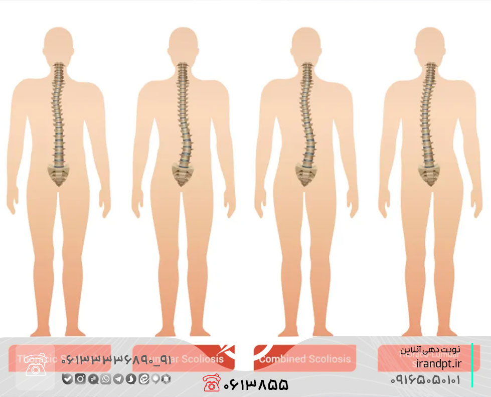 درمان انحراف ستون فقرات یا اسکولیوز با فیزیوتراپی