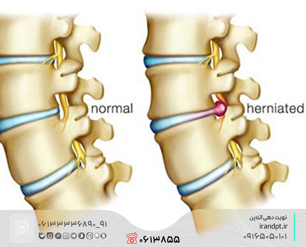 درمان دیسک کمر با فیزیوتراپی
