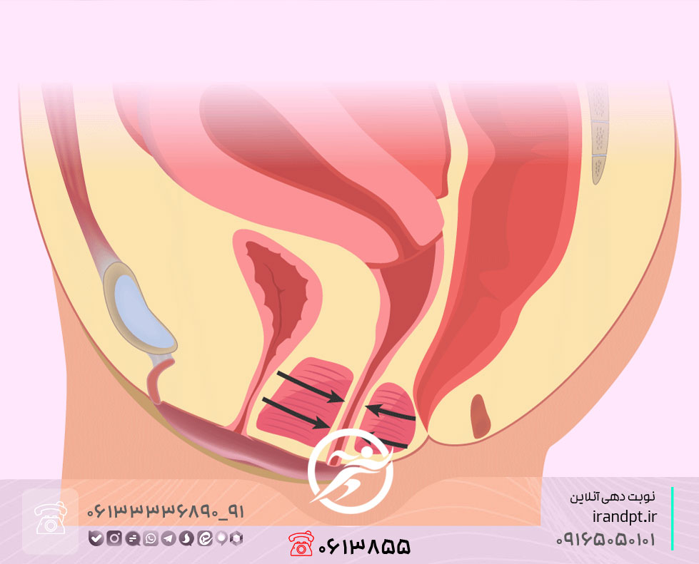 درمان واژینیسموس با فیزیوتراپی