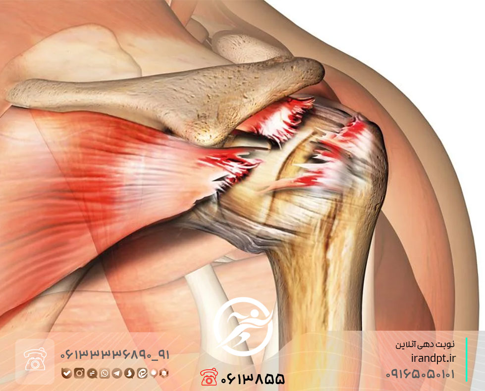 درمان پارگی تاندون شانه با فیزیوتراپی