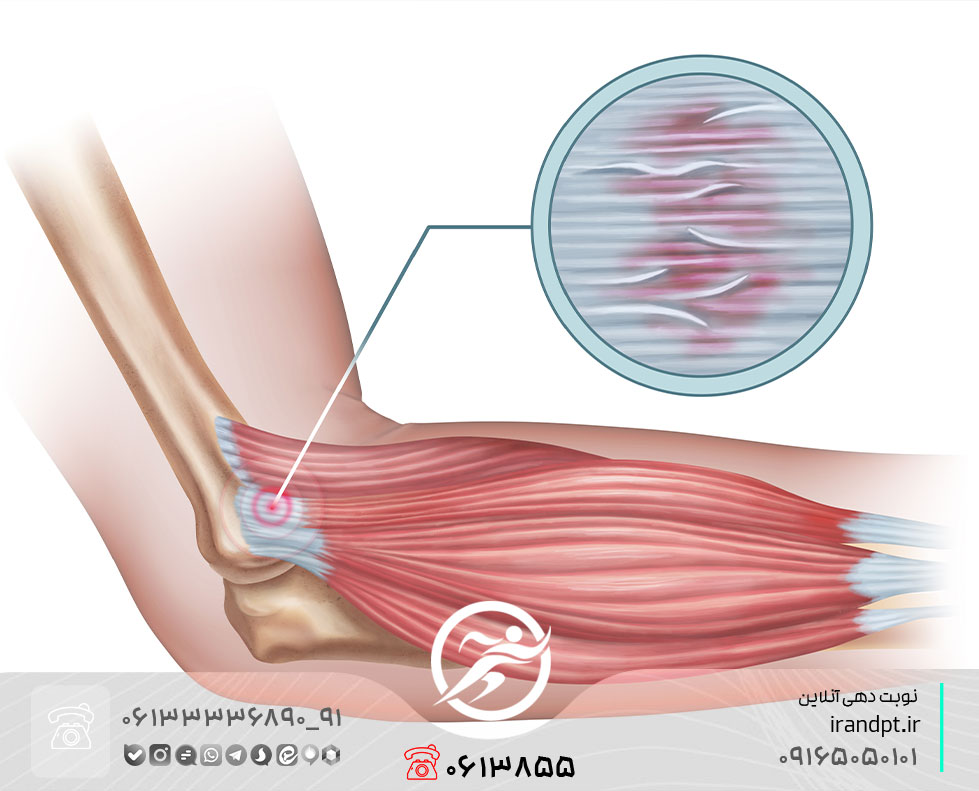درمان درد تاندون داخلی آرنج با فیزیوتراپی