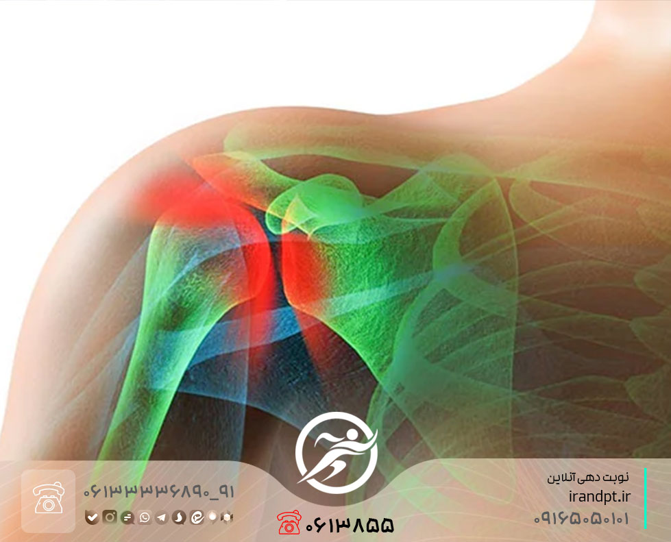 درمان گیر افتادن تاندون شانه با فیزیوتراپی