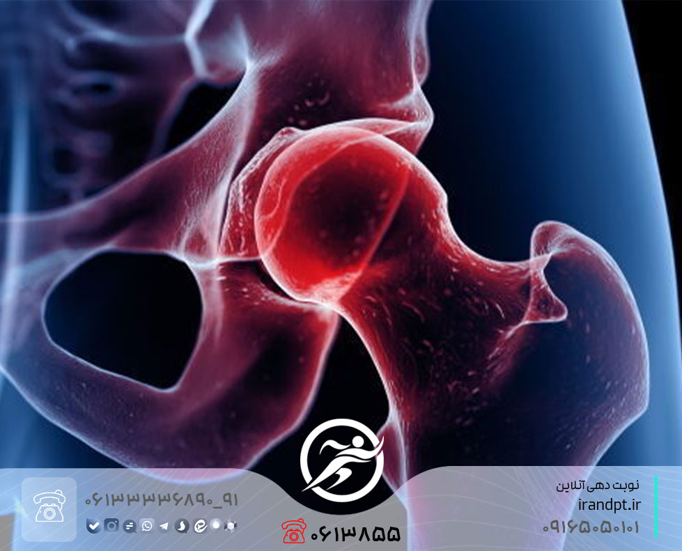 درمان آرتروز مفصل لگن با فیزیوتراپی