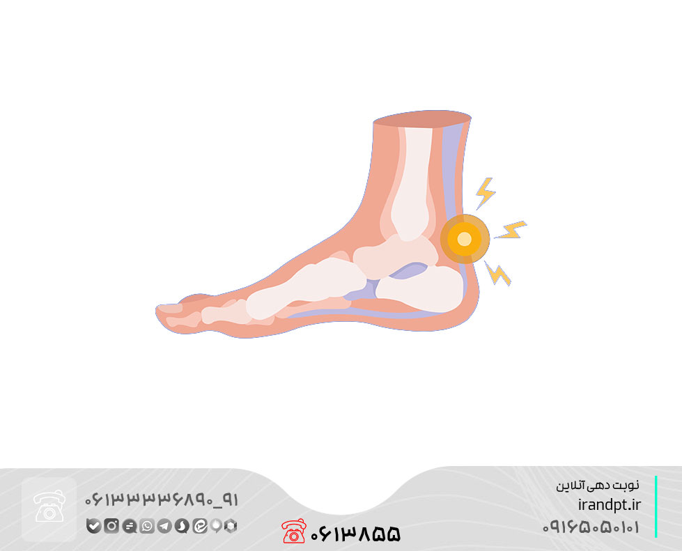 درمان کشیدگی تاندون آشیل مچ پا با فیزیوتراپی