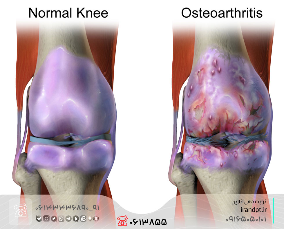 درمان آرتروز زانو با فیزیوتراپی