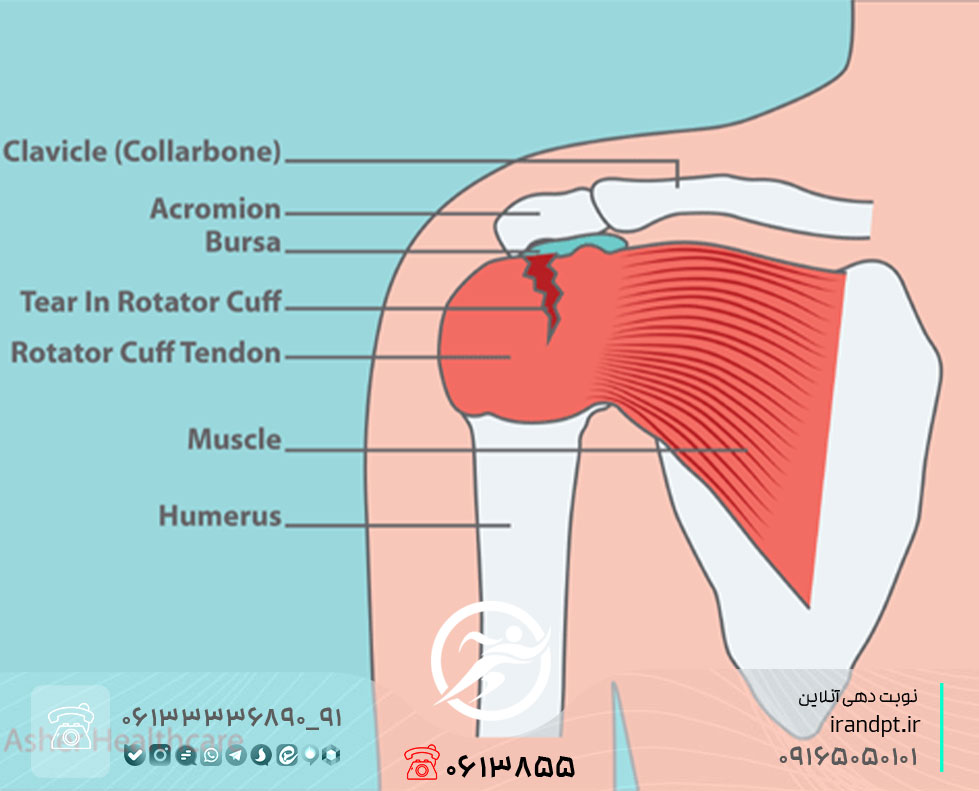 درمان کشیدگی و پارگی عضلات روتاتور کاف (کلاهک گرداننده) شانه با فیزیوتراپی