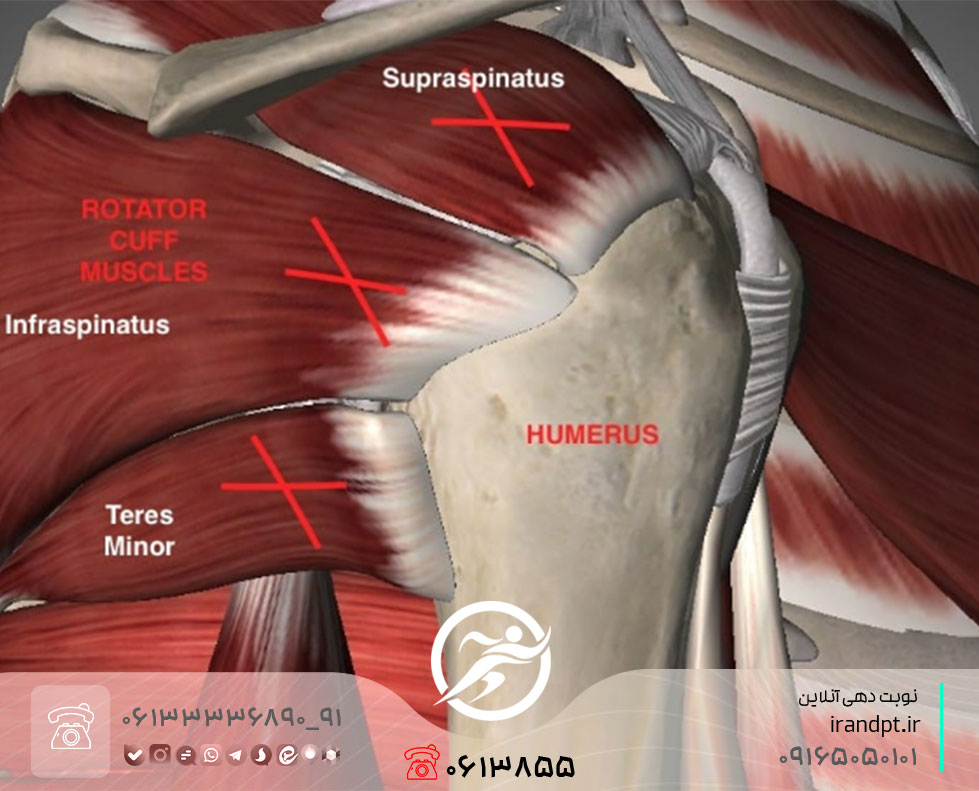 درمان کشیدگی و پارگی تاندون سوپراسپیناتوس شانه با فیزیوتراپی